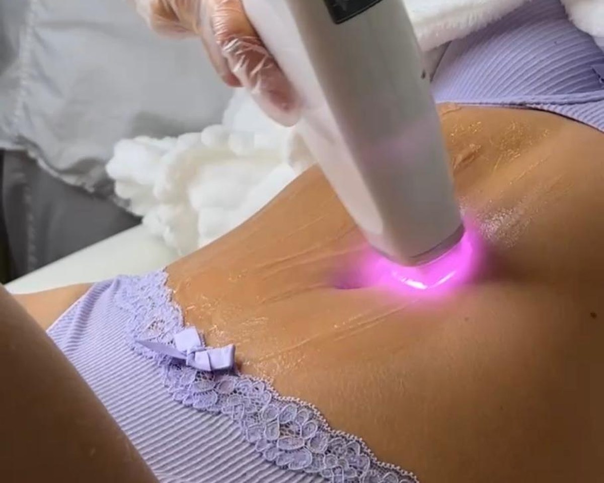 Laserbehandling hos Skinlab Lund, laserpulsen syns mot huden